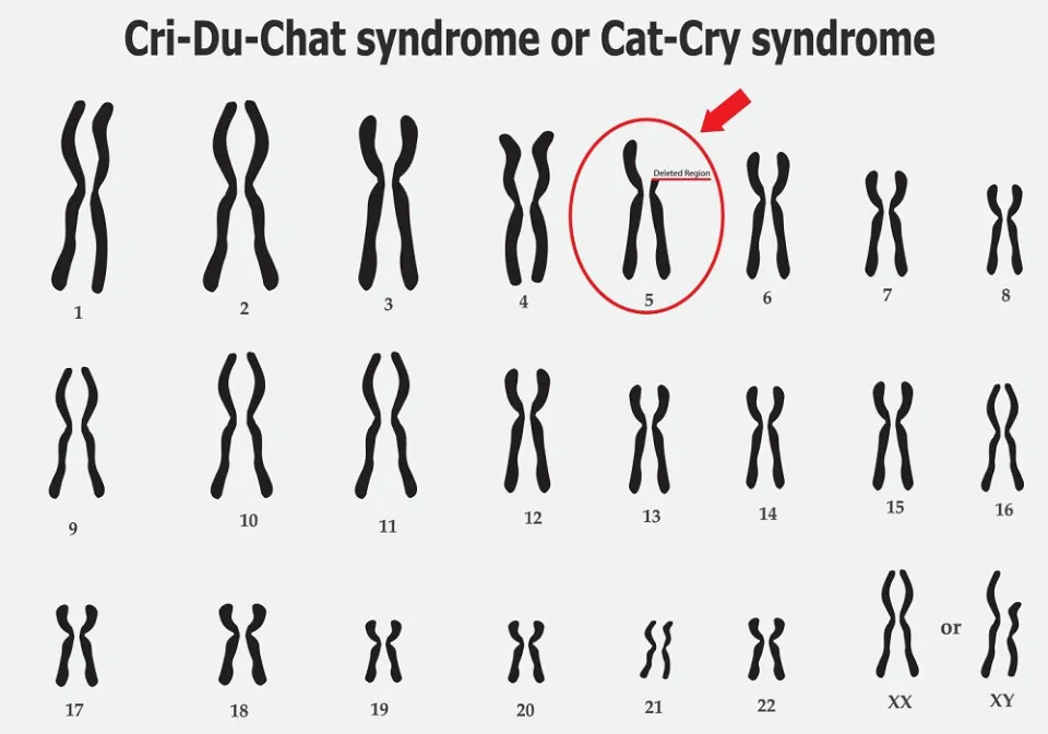 syndrome cri du chat